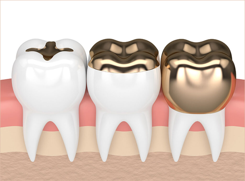 couronnes illustration