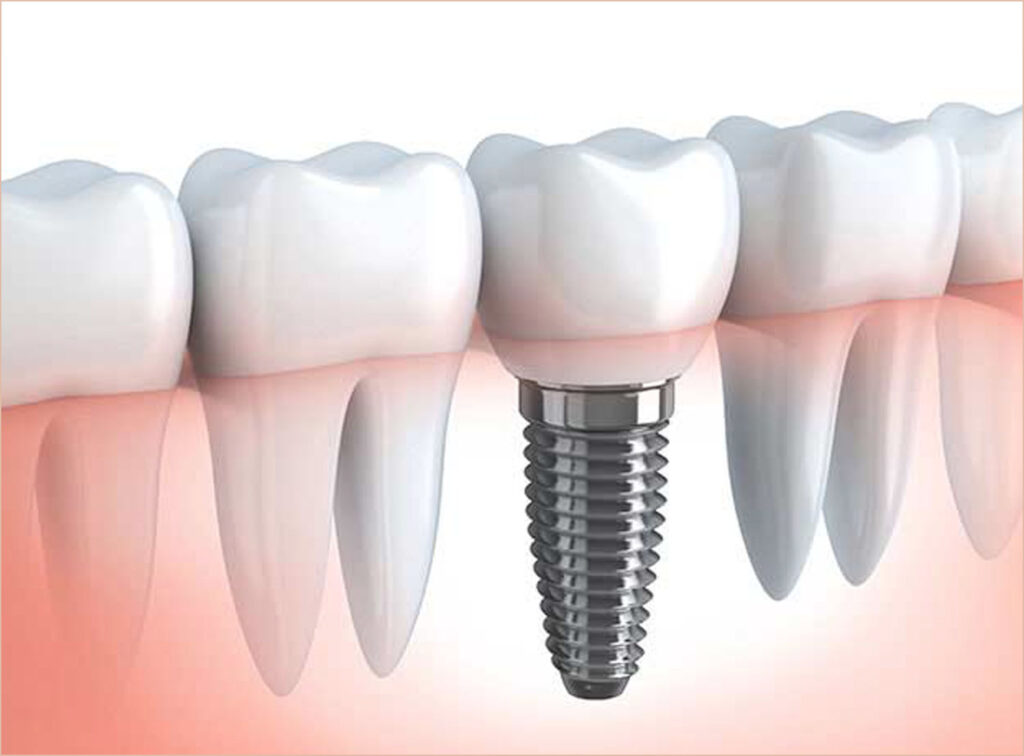 Implants