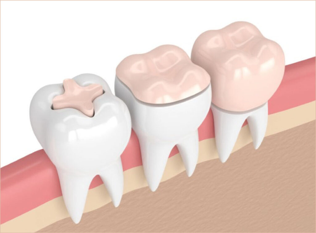 inlays illustration