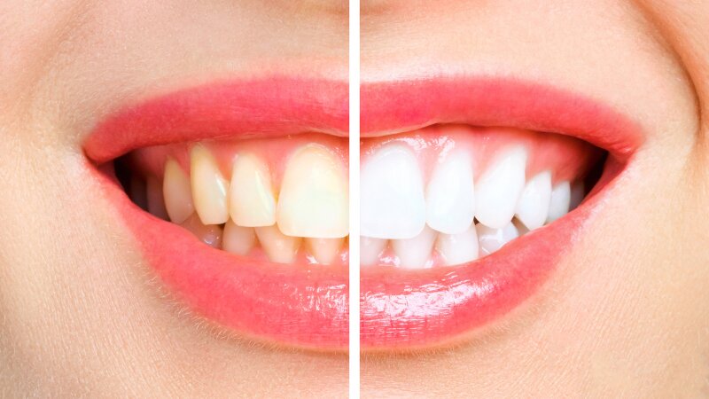 Un comparatif de la couleur des dents avant et après un traitement de blanchiment