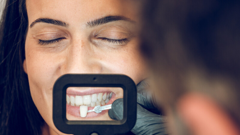 Un dentiste en train de choisir des facettes pour améliorer les dents d'une cliente