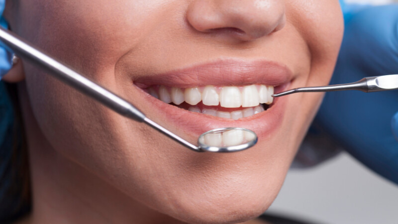 Une femme qui avait un sourire moche transformé en sourire parfait grâce à un bon dentiste