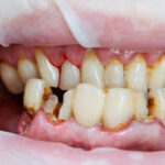 Une personne ayant besoin de restauration de dents usées