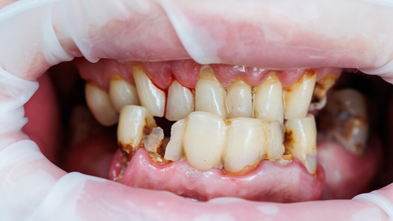Une personne ayant besoin de restauration de dents usées