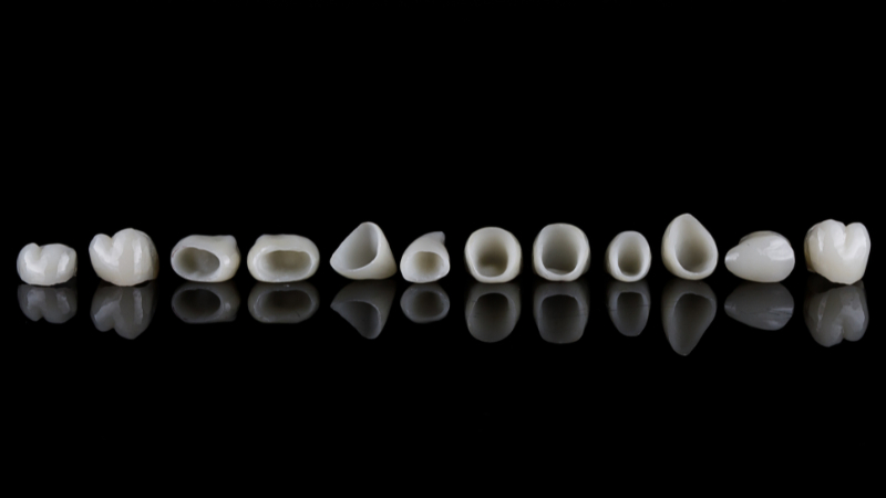 Comparaison de différentes facettes en céramique, en zircone et en composite