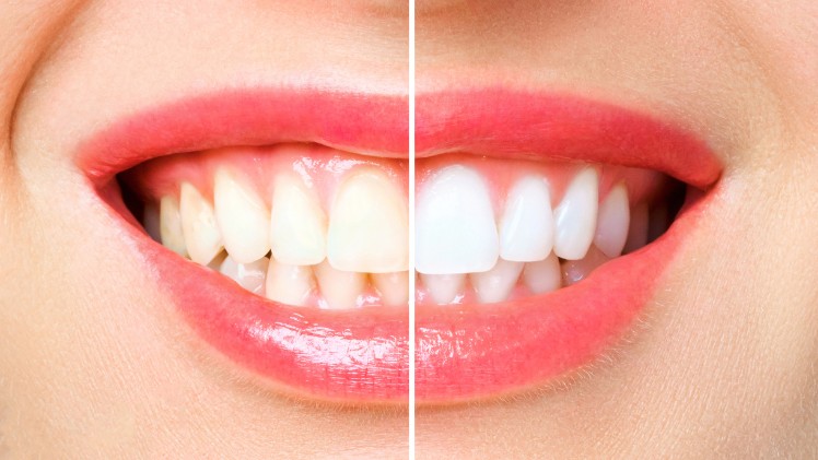 Des dents avec et sans blanchiment dentaire