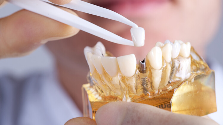 La démonstration d'un implant en zircone