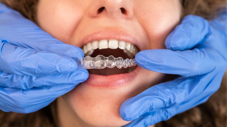 Un dentiste en train de poser une gouttière d'alignement dentaire sur une patiente