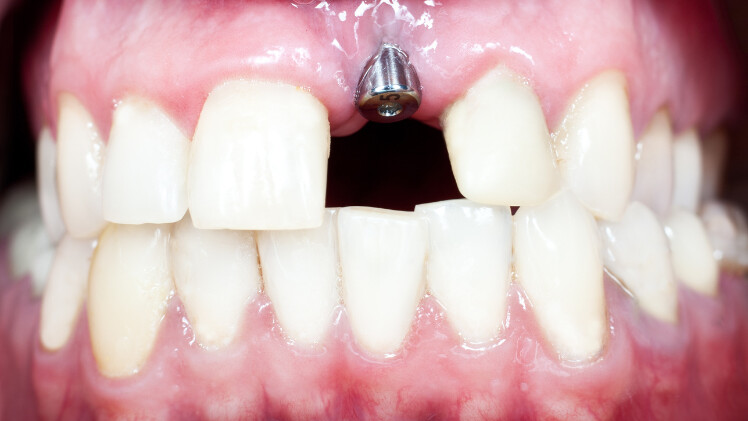 Une bonne ostéo-intégration d'un implant dentaire