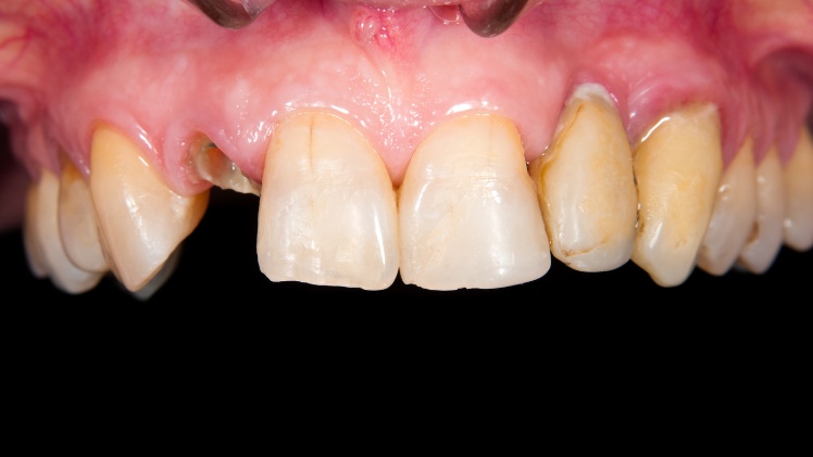 Des dents dévitalisées