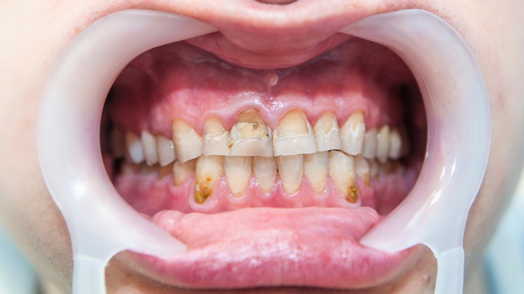 Des tâches blanches dûes à une fluorose dentaire