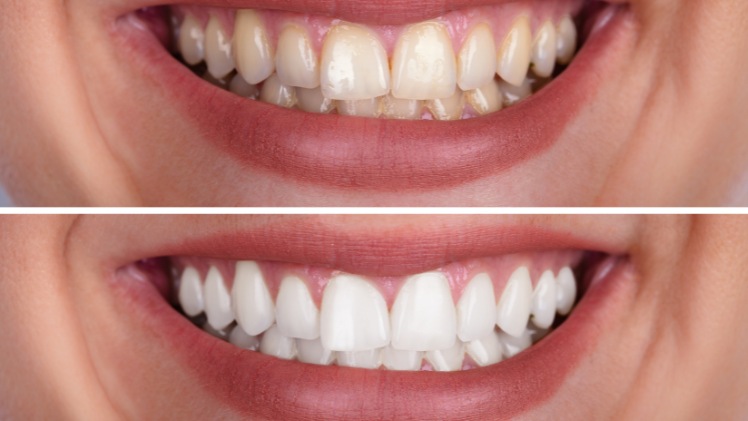 Les dents avant et après un blanchiment dentaire