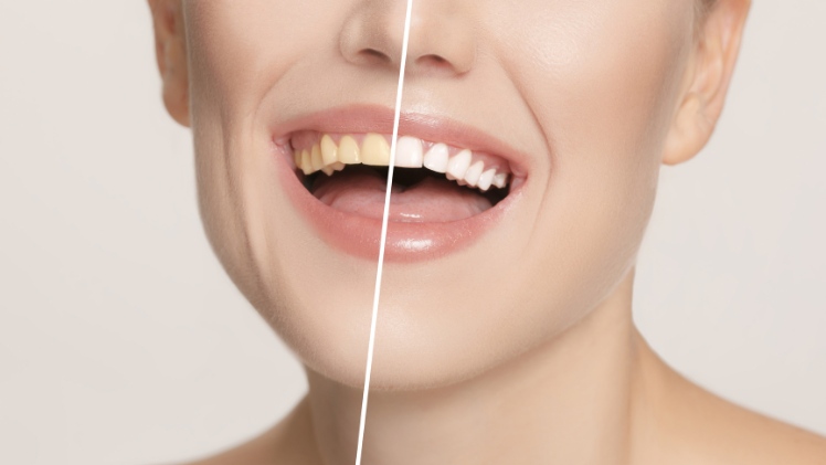 Les dents d'une femme avant et après un blanchiment dentaire
