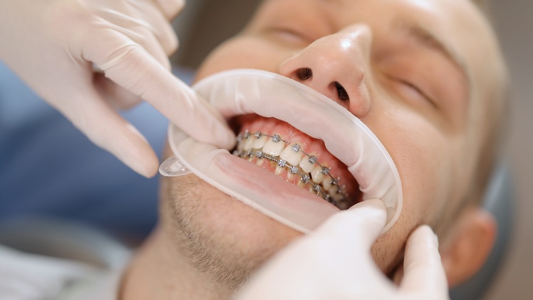 L'orthodontie dentaire utilisée pour l'alignement des dents d'un patient