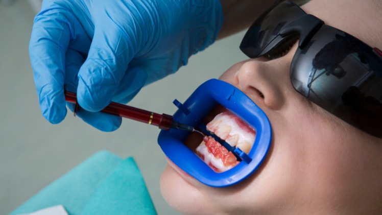 Technique pour blanchir une dent dévitalisée
