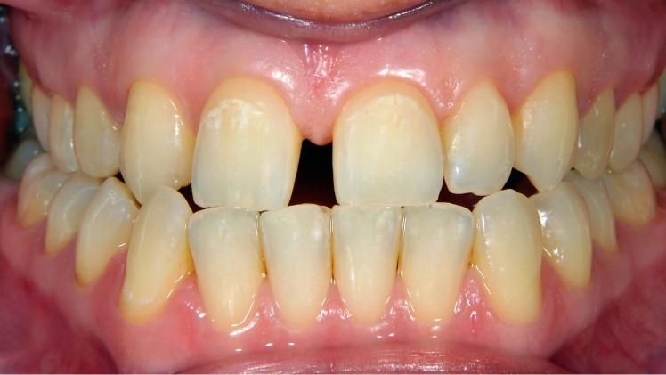 Un patient avec des tâches blanches sur les dents