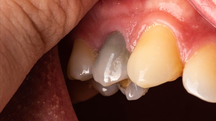 Une dent dévitalisée noire d'un patient