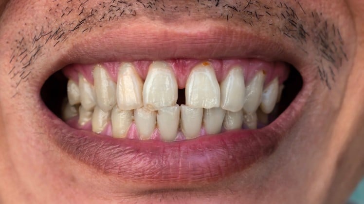 Des dents du bonheur moches
