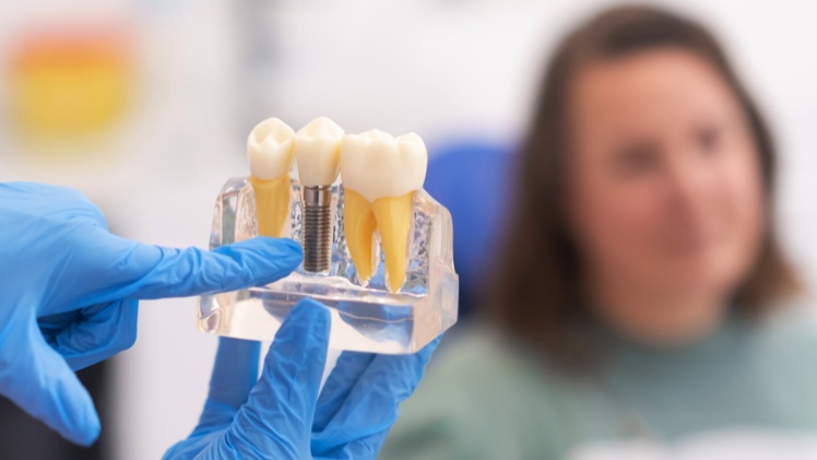 Une présentation du fonctionnement d'un implant dentaire