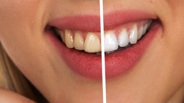 Comparaison de dent en titane et de dent en zircone