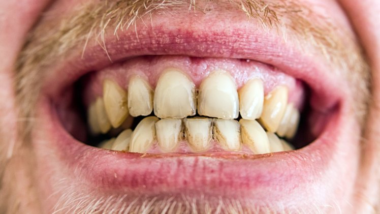 Des plaques à cause d'une mauvaise hygiène dentaire
