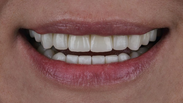 Matière pour un implant dentaire, la céramique