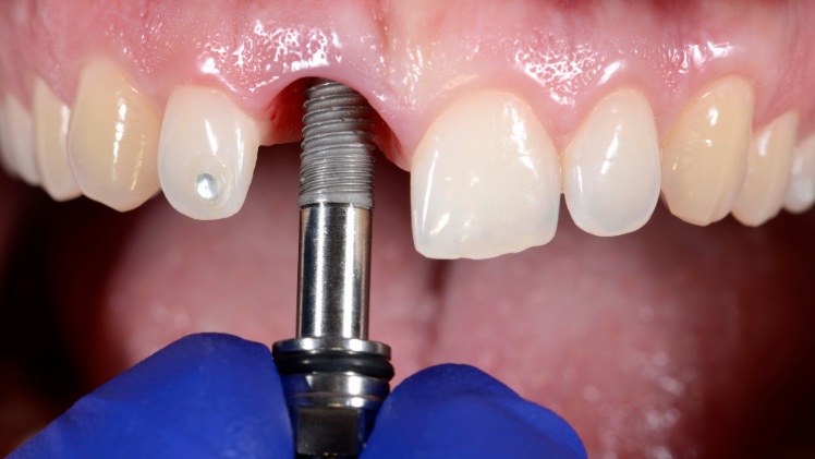 Un implant dentaire en titane