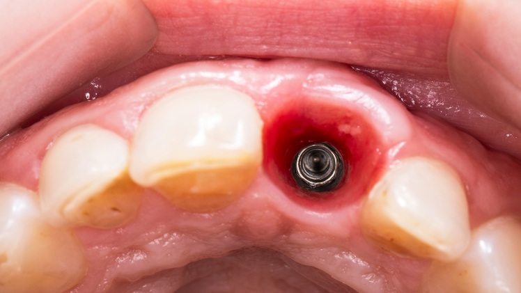 Un implant dentaire pas encore entièrement cicatrisé