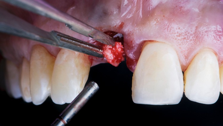 Un patient avec un problème d'implant dentaire