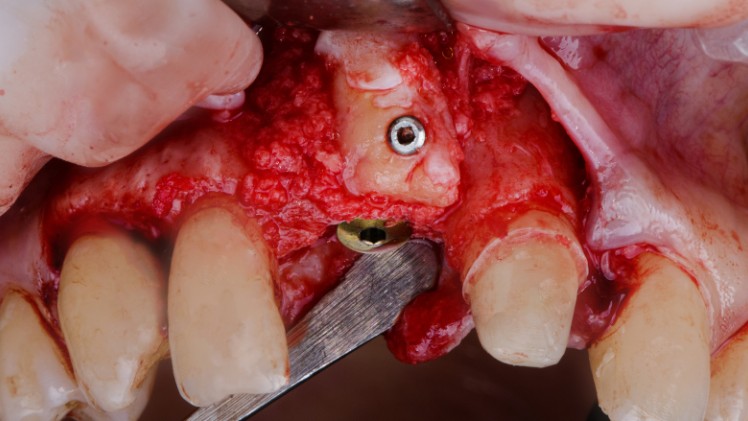 Une perte osseuse à cause d'une infection autour de l'implant dentaire
