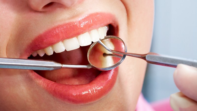 Un surfaçage dentaire chez le dentiste