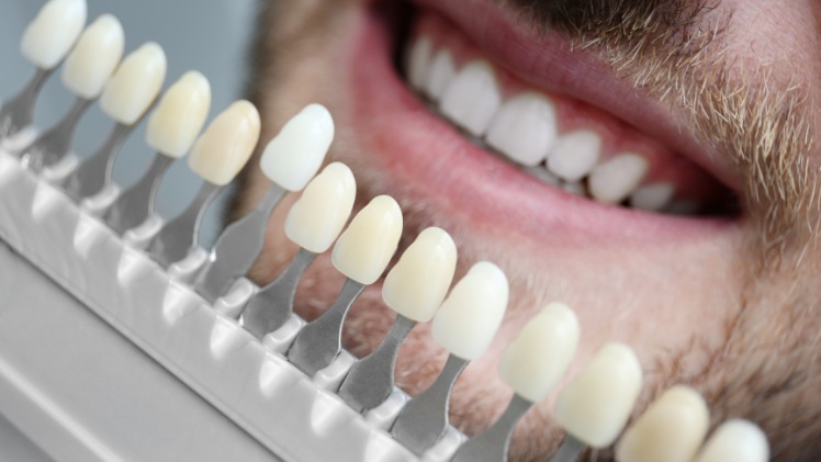 Différentes facettes dentaires au choix pour aligner les dents