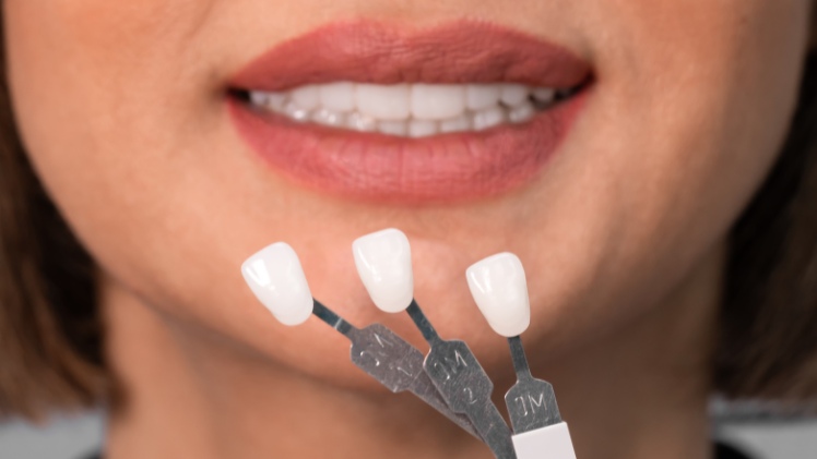 Une femme qui tient des facettes dentaires pour aligner ses dents