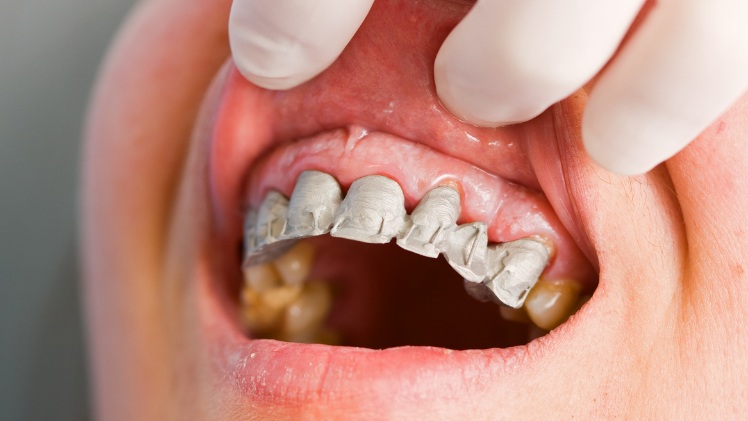 Un appareil dentaire fixe sur un patient