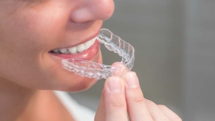 Un appareil dentaire transparent pour adulte