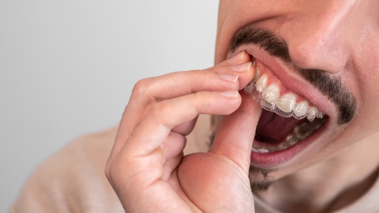 Un homme qui installe sa gouttière d'alignement dentaire