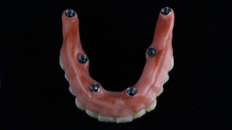 Une prothèse pour un implant all-on-six