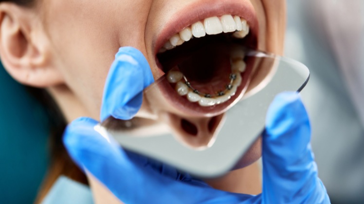 Une cliente ayant choisi l'orthodontie dentaire linguale