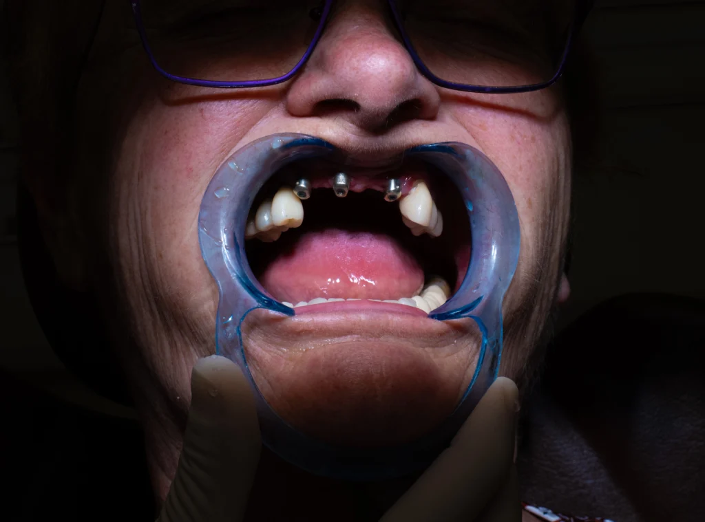 Dents d'un patient avant la pose d'un implant dentaire à la Clinique du Sourire à Die