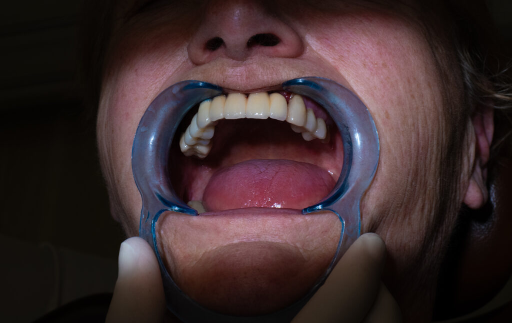 Résultat après cicatrisation et intégration d'implants dentaires