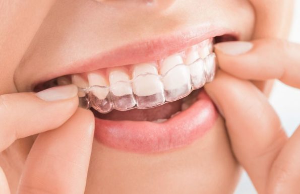 invisalign illustration